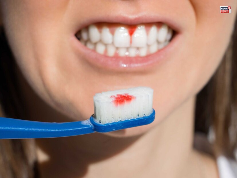 পেরিওডোন্টাল ডিজিজের লক্ষণ (Periodontal Disease symptom) ফ্যাক্সওয়েবসাইটের মতে, গাম থেকে রক্তপাতের অনেক কারণ থাকতে পারে। আমেরিকান ডেন্টাল অ্যাসোসিয়েশনের মুখপাত্র এবং আমেরিকার পেরিওডোন্টিস্ট স্যালি জে. ক্র্যামের মতে, অনেক সময় মাড়ির ফোলার কারণে ব্রাশ করার সময় রক্ত আসতে শুরু করে যা মাড়ির রোগের প্রাথমিক লক্ষণ হয়।