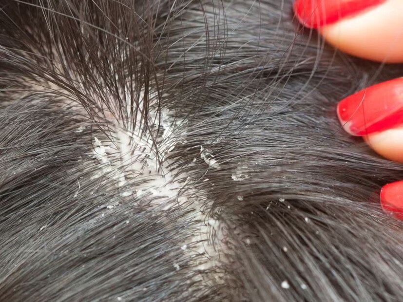 অযাচিত অতিথীর মতো একবার জেঁকে বসলে আর যাওয়ার নামই ধরে না। নামি দামি শ&#x200d;্যাম্পু থেকে সিরাম, কোনও কিছুতেই কাজ দেয় না। ঘরোয়া টোটকাও বেশিরভাগ ক্ষেত্রেই দেখা যায় ফেল। 