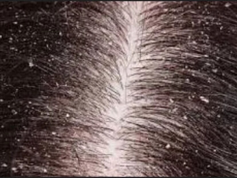 এবার এই জল মাথায় মেখে রাখতে হবে অন্তত ১৫ থেকে ২০ মিনিট মাথায় মেখে রাখতে হবে। তারপর স্বাভাবিকভাবে শ&#x200d;্যাম্পু করে মাথা ধুয়ে নিলেই খুশকি মুক্ত হবে চুল। 