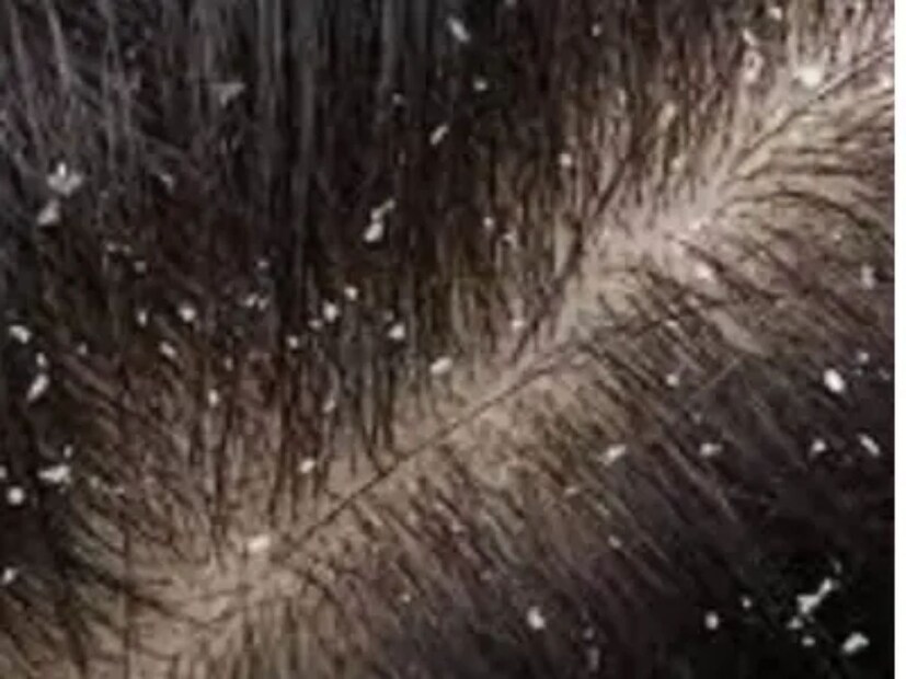 কখনও সখনও কিছু দিনের জন&#x200d;্য বিদায় নিলেও ফের না চাইতেই উড়ে এসে জুড়ে বসে খুশকি। খুশকির কারণে কেবল চুল পড়া নয়, আরও অনেক সমস&#x200d;্যা দেখা যায়। 