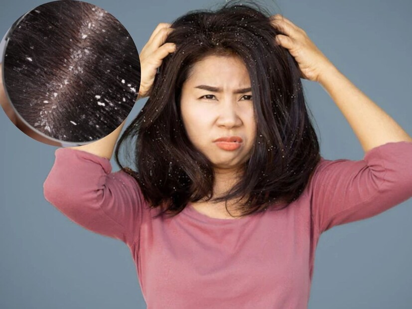 চুল পড়ার একটি বড় কারণ হল খুশকি। খুশকির সমস&#x200d;্যায় ভুক্তভোগী একাধিক মানুষ। চুলের গোড়ায় সাদা ছত্রাকের উপদ্রবে নাজেহাল অনেকে। 