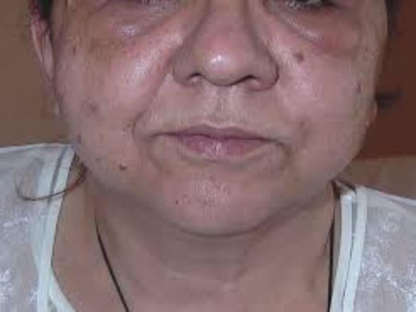 মুখের ফোলাভাব কিডনির ক্ষতির লক্ষণও হতে পারে। যদি কোনও অ্যালার্জি ছাড়াই হঠাৎ মুখে ফোলাভাব দেখা দেয়, তবে তা উপেক্ষা করা উচিত নয়।