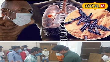 যক্ষ্মা