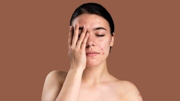 শীতে শুষ্ক, খসখসে ত্বক? মুখ ভর্তি দাগ-ছোপ? কসমেটিক্স নয়, একটু ফিটকিরিতেই ফিরবে গ্ল্যামার