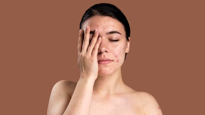 Summer Boils Remedies: গরমকালে কেন শরীরে বাড়ে ফোড়া-ফুসকুড়ির সমস্যা? কীভাবে মিলবে এই সমস্যা থেকে মুক্তি, এখনই জানুন… Summer Boils Remedies: গরমকালে কেন শরীরে বাড়ে ফোড়া-ফুসকুড়ির সমস্যা? কীভাবে মিলবে এই সমস্যা থেকে মুক্তি, এখনই জানুন…