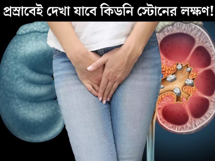 শরীরের ছাঁকনির কাজ করে কিডনি। কিডনি ভাল থাকা খুব গুরুত্বপূর্ণ। তবে বর্তমানে বেড়েছে কিডনি স্টোনের সমস&#x200d;্যা। প্রচুর মানুষেরই কিডনিতে হচ্ছে পাথর। 