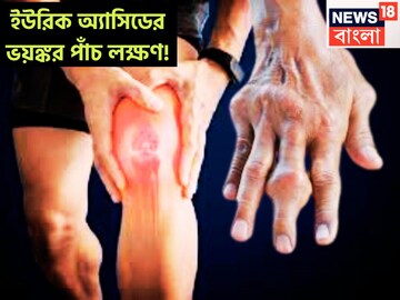 ইউরিক অ্যাসিডের ভয়ঙ্কর পাঁচ লক্ষণ! এড়িয়ে গেলেই পড়তে হবে বড় ফাঁদে