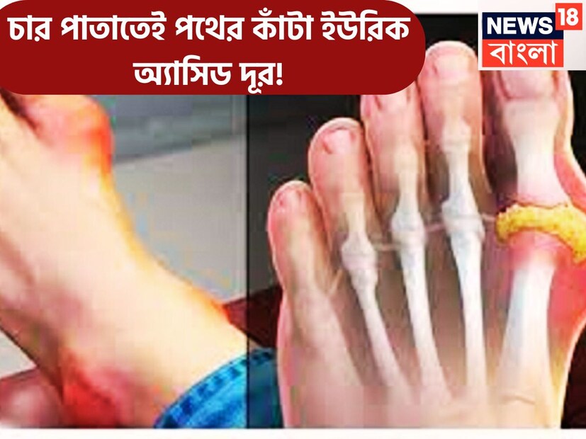 আজকের দিনে ইউরিক অ্যাসিড সত্যি সত্যি একটি গুরুত্বপূর্ণ সমস্যা ৷ কিডনি শরীরের বিপাকজাত দ্রব্য ফিল্টার করে ইউরিক অ্যাসিড ছেঁকে বের করে সেটি দূষিত পদার্থ আকারে শরীরের বাইরে বেরিয়ে যায় ৷ প্রতীকী ছবি ৷