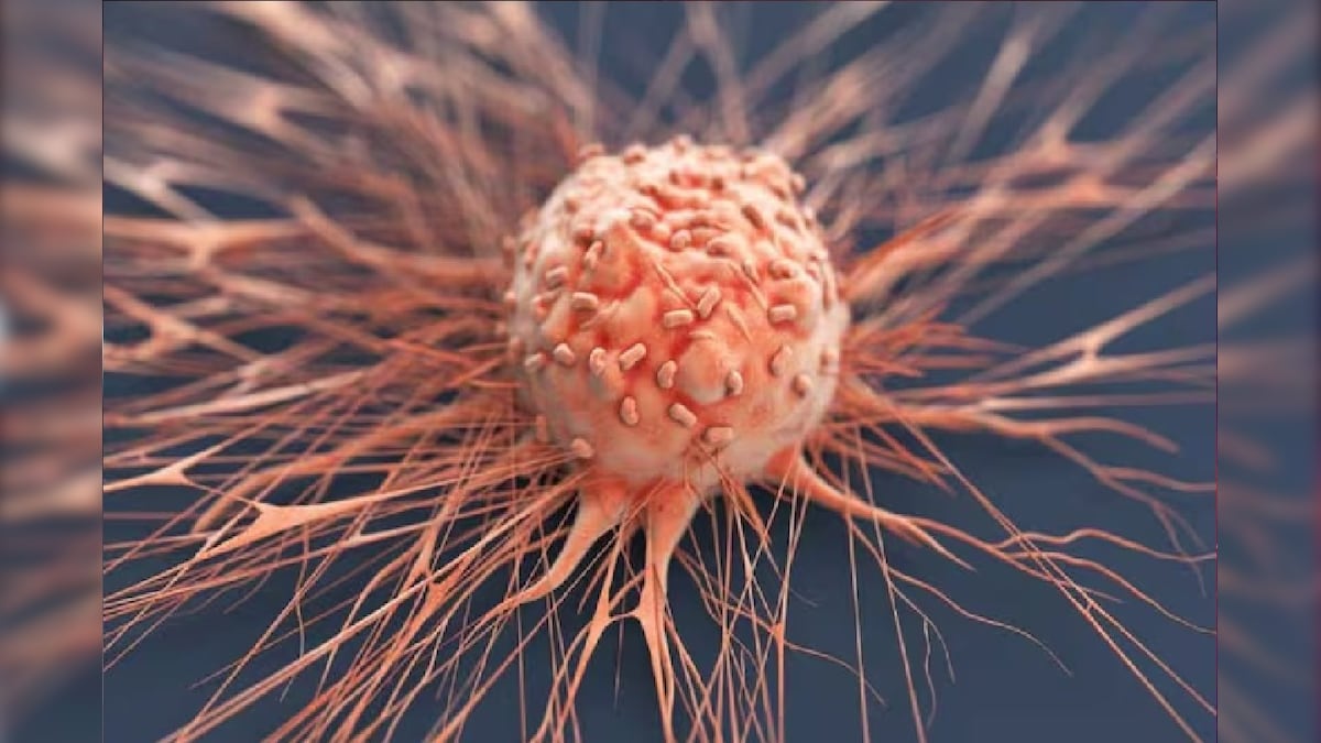 Cases related to colon cancer rising in India know early symptoms stay alert