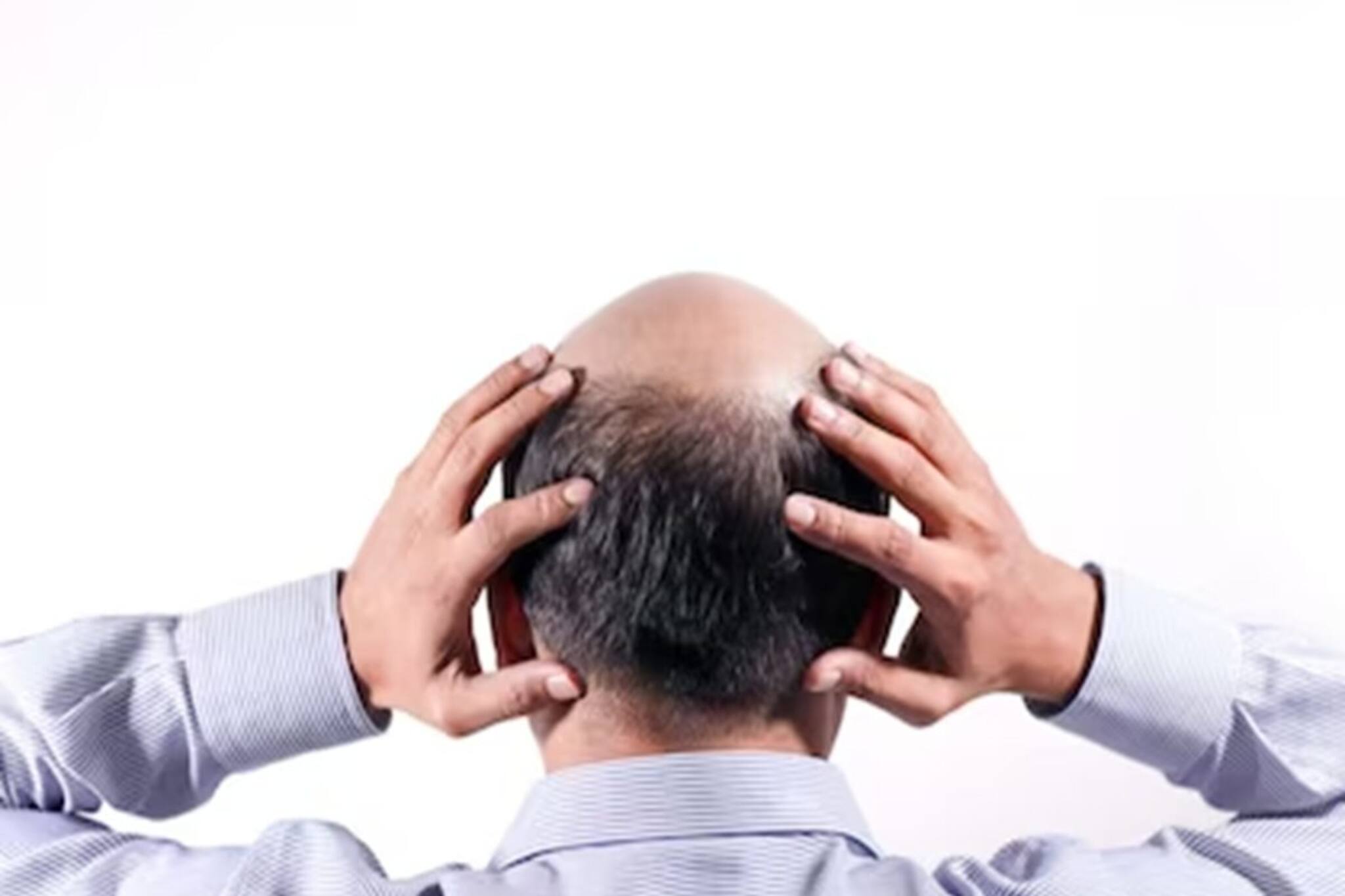 স্রেফ ১০০ টাকায় টাক পড়ার মুশকিল আসান,শানু বাবার আয়ুর্বেদিক ওষুধে ২ সপ্তাহে সমস্যার সমাধান