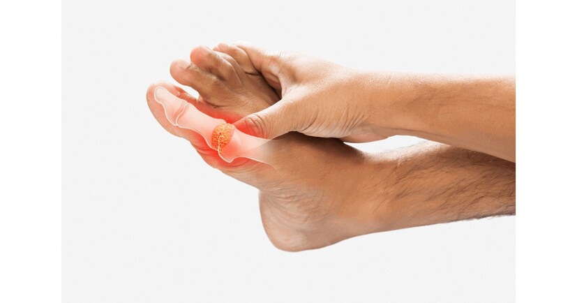 সকালে ঘুম থেকে উঠেই কি হাড়ের গিট (Joints) শক্ত হয়ে যায়? হাঁটু, পায়ের আঙুল বা হাতের আঙুলে তীব্র ব্যথা অনুভব করছেন? তাহলে আপনি হাই ইউরিক অ্যাসিড সকালে ঘুম থেকে উঠেই কি হাড়ের গিট (Joints) শক্ত হয়ে যায়? হাঁটু, পায়ের আঙুল বা হাতের আঙুলে তীব্র ব্যথা অনুভব করছেন? তাহলে আপনি হাই ইউরিক অ্যাসিড