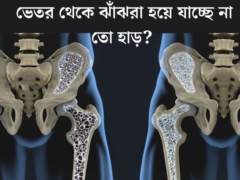 এ যেন হাড়ে লাগা ঘুনপোকা। ভেতর থেকে কুরে কুরে খেয়ে ঝাঁঝরা করে দিচ্ছে শক্তসমর্থ হাড়কে। এমনই ভয়ঙ্কর এই রোগ। মারাত্মক এই রোগের প্রভাব ক্রমশ বেড়ে চলেছে দিনের পর দিন।