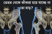 হাড়কে ঘুণপোকার মতো ভেতর থেকে কুরে কুরে ঝাঁঝরা করে দেয় এই রোগ! ৫ লক্ষণ দেখলেই সতর্ক হন