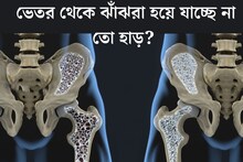 হাড়কে ঘুণপোকার মতো ভেতর থেকে কুরে কুরে ঝাঁঝরা করে দেয় এই রোগ! ৫ লক্ষণ দেখলেই সতর্ক হন