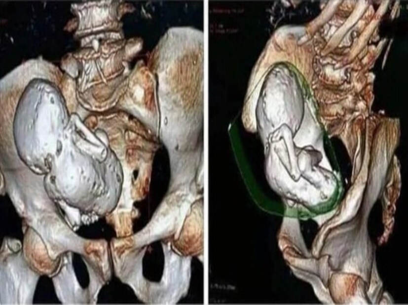 স্বাস্থ্য বিশেষজ্ঞদের মতে, লিথোপেডিয়ন (Lithopedion) একটি অত্যন্ত বিরল চিকিৎসাগত অবস্থা, যেখানে ভ্রূণটি গর্ভাশয়ের পরিবর্তে পেটের মধ্যে (অ্যাবডোমেনে) বেড়ে ওঠে। এরপর যখন সেই ভ্রূণটি মারা যায়, তখন শরীর সেটিকে একটি পাথরের মতো বস্তুতে রূপান্তরিত করে, অর্থাৎ তার চারপাশে ক্যালসিয়ামের আস্তরণ গঠন করে। এটি ঘটে কারণ ভ্রূণটি যখন পেটের গহ্বরে বেড়ে ওঠে, তখন সেখানে পর্যাপ্ত রক্ত প্রবাহ থাকে না। সেই কারণে মৃত ভ্রূণটি শরীর থেকে নিজে থেকে বেরিয়ে আসতে পারে না এবং শরীর সেটিকে একটি অচেনা বস্তু বা ফরেন অবজেক্ট হিসেবে চিহ্নিত করে। এরপর শরীরের ইমিউন সিস্টেম বা রোগ প্রতিরোধ ক্ষমতা তার চারপাশে ক্যালসিয়াম জমাতে থাকে, যার ফলে এটি ধীরে ধীরে পাথরের মতো শক্ত হয়ে যায় এবং একে বলা হয় স্টোন বেবি। Image: X Handle