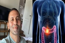 কোলন ক্যানসারে মৃত্যু অভিনেতা বিভু রাঘবের, শরীরের কোন কোন উপসর্গ এই মারণ রোগের জানান দেয়?
