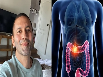 ভারতে দ্রুত বাড়ছে কোলন ক্যানসার! এই খাবারগুলি ভুলেও ছোঁবেন না, সতর্ক না হলেই ভয়ঙ্কর বিপদ ভারতে দ্রুত বাড়ছে কোলন ক্যানসার! এই খাবারগুলি ভুলেও ছোঁবেন না, সতর্ক না হলেই ভয়ঙ্কর বিপদ