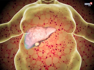 লিভার ঠিক থাকলে শরীর ঠিক! ফ্যাটি লিভার কমাতে কফি, গ্রিন টি, বিটরুট জুস অপরিহার্য