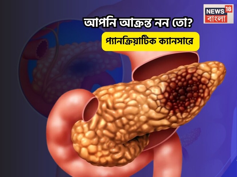 কীভাবে নিজেকে সুরক্ষিত রাখবেন?- নিয়মিত ব্যায়াম করুন, যোগব্যায়াম করুন। - প্যাকেটজাত, প্রক্রিয়াজাত খাবার এড়িয়ে চলুন। - ধূমপান করবেন না। ধূমপায়ীদের থেকে দূরে থাকুন। - রেড মিট এবং অন্যান্য আমিষ খাবারের পরিবর্তে সবুজ শাকসবজি খান। - ওজন বাড়তে দেবেন না। -লিভারকে দুর্বল করে এমন খাবার থেকে দূরে থাকুন। - চিনি খাবেন না। ৪৫ বছর বয়সের পর নিয়মিত স্বাস্থ্য পরীক্ষা করান । 