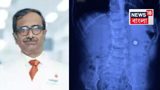 ছোট ছোট অস্ত্রোপচারের মাধ্যমে অত্যন্ত সতর্কতার সঙ্গে ব্যাটারিটি বের করা হয়, ছোট ছোট অস্ত্রোপচারের মাধ্যমে অত্যন্ত সতর্কতার সঙ্গে ব্যাটারিটি বের করা হয়,