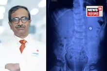 ম্যাগনেটিক ব্যাটারি গিলে ফেলে দেড় বছরের শিশু! চিকিৎসকদের তৎপরতায় সুস্থ জটিল অস্ত্রোপচারে