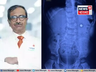 ছোট ছোট অস্ত্রোপচারের মাধ্যমে অত্যন্ত সতর্কতার সঙ্গে ব্যাটারিটি বের করা হয়,