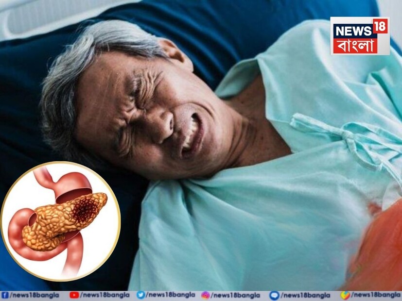 *অগ্ন্যাশয় ক্যানসার কোষ বৃদ্ধির কারণে সৃষ্ট একটি বিপজ্জনক রোগ। এটি খুব দ্রুত ছড়িয়ে পড়ে না, তবে স্বাস্থ্যের উপর মারাত্মক প্রভাব ফেলতে পারে। সচেতনতার অভাবে এই ক্যানসারে আক্রান্তের সংখ্যা আশঙ্কাজনকভাবে দিন দিন বেড়েই চলেছে।
