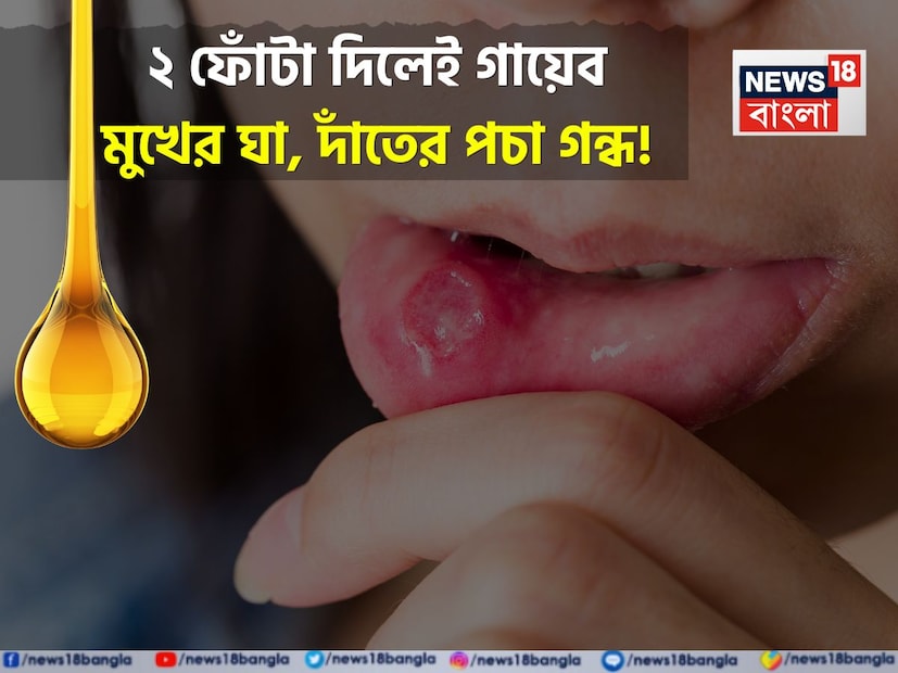 মুখের আলসার থেকে মুক্তি পেতে, আপনি আয়ুর্বেদিক কিছু জিনিস ব্যবহার করতে পারেন। এতে পার্শ্বপ্রতিক্রিয়ার কোনও ঝুঁকি নেই এবং শরীরের অভ্যন্তরীণ অঙ্গগুলির উপর কোনও খারাপ প্রভাব পড়ার কোনও চিন্তা নেই। এগুলি ব্যবহার করার সাথে সাথেই আলসারের জ্বালাপোড়া এবং ফোলাভাব থেকে মুক্তি পাওয়া শুরু হয়।