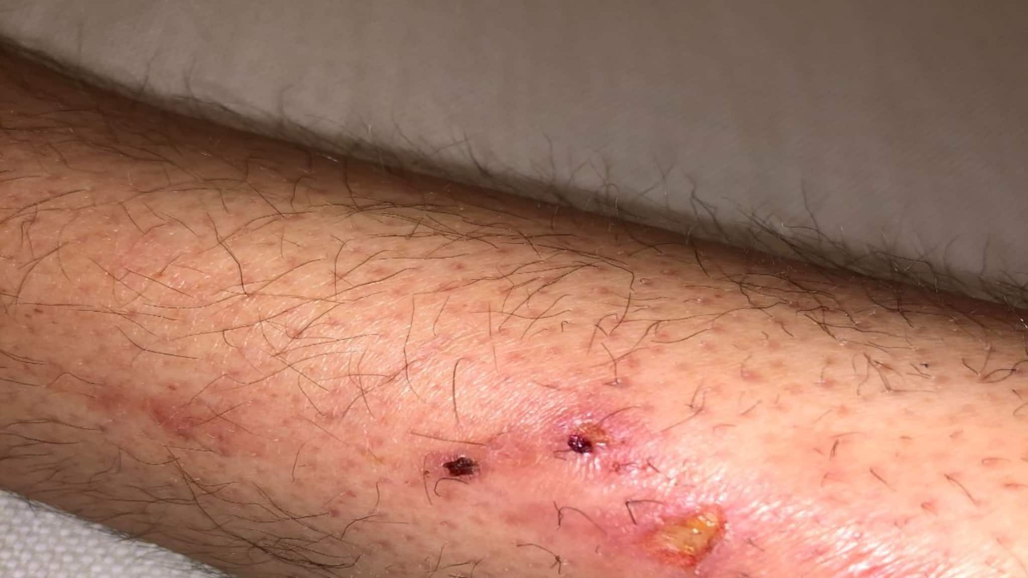 বর্ষায় সাপের কামড়...! মুহূর্তে শরীরে ছড়িয়ে যায় 'বিষ'! বাঁচতে কী করবেন? কী করবেন না? জানুন বিশেষজ্ঞদের পরামর্শ!