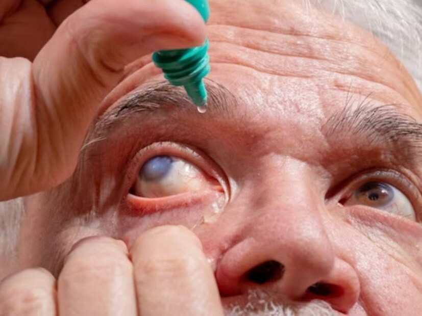 *অকুলার ক্যানসার (Ocular cancer) খুবই বিরল রোগ। প্রথমে, তার লক্ষণগুলি খুব সুস্পষ্ট বোঝা যায় না। তবে, যদি কিছু লক্ষণ লক্ষ্য করা যায়, তবে অবিলম্বে একটি স্ক্রিনিংয়ের পরামর্শ দেওয়া হয়।