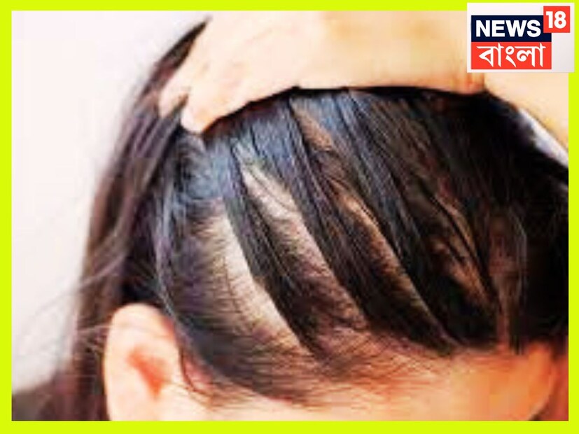 নারকেল বা বাদাম তেল হালকা বা আলতো করে চুলের গোড়ায় রাখতে হবে ৷ গরমে বেশি করে চুলে তেল দিলে চিপচিপ হতে পারে, এতে চুলের ক্ষতিও হতে পারে, সেই কারণে সাবধানে থাকতে হবে এসবের থেকে ৷ প্রতীকী ছবি ৷