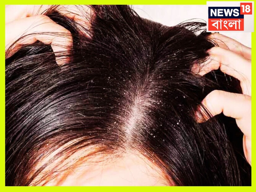চুল ভাল রাখতে খাদ্য তালিকায় প্রোটিন ও আয়রনের ভরপুর যোগান রাখুন ৷ এই জন্য অঙ্কুরিত, ছোলা বা আনাজ, পালংশাক, ডিম, ডাল, বাদাম অত্যন্ত জরুরি, তবে চিকিৎসকের সঙ্গে আলোচনা সাপেক্ষেই সকল পদক্ষেপ প্রয়োজন ৷ প্রতীকী ছবি ৷