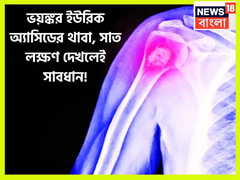 শরীরে ইউরিক অ্যাসিড বৃদ্ধিপ্রাপ্ত হলেই কয়েকটি লক্ষণ দেখতে পাওয়া যায়, সাতটি ভয়ঙ্কর সঙ্কেত লক্ষ্য করে এড়িয়ে গেলে চলবেনা ৷ প্রতীকী ছবি ৷