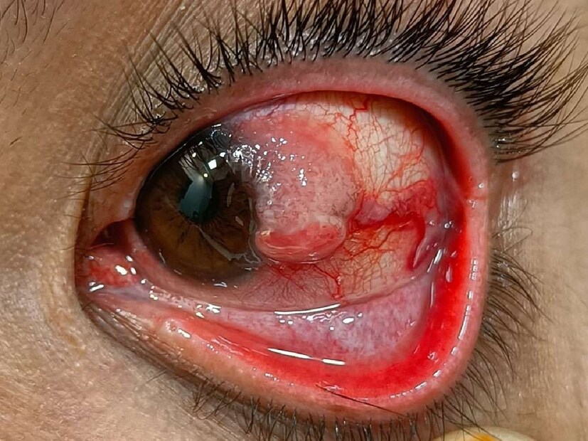 *চোখের ক্যানসার (Eye Cancer) হল চোখের মধ্যে বা চারপাশে অস্বাভাবিক কোষের বৃদ্ধি। এটি চোখের বিভিন্ন অংশে যেমন রেটিনা, ইউভিয়া, বা চোখের পাতার চারপাশে বিকশিত হতে পারে। চোখের ক্যানসারের বিভিন্ন প্রকার রয়েছে এবং প্রত্যেকটির নিজস্ব লক্ষণ ও চিকিৎসা রয়েছে। প্রাথমিক পর্যায়ে শনাক্তকরণ রোগ নিয়ন্ত্রণের জন্য গুরুত্বপূর্ণ।