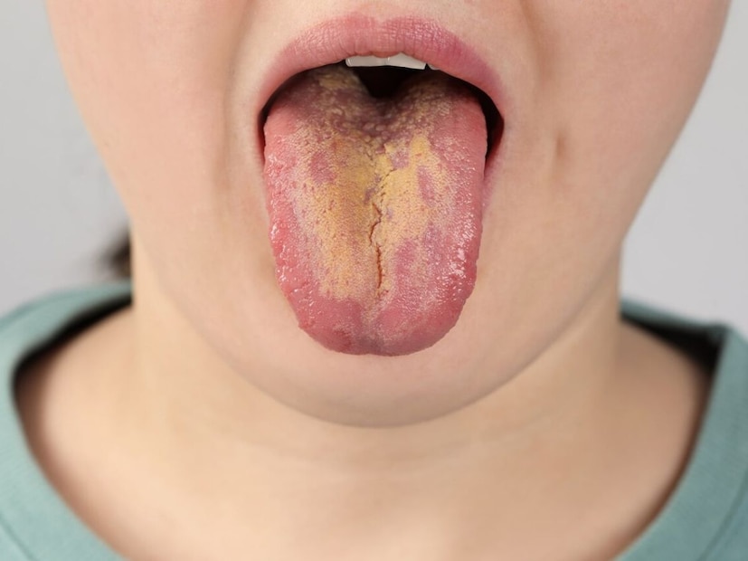 হলুদ জিভ (Yellow Tongue): নিউট্রিশনিস্ট শ্বেতা শাহ জানালেন যদি জিভ হলুদ রঙের দেখায়, তাহলে এটি শরীরে পিত্ত দোষ বাড়ার, এসিডিটি বা বাইল জুসের অসামঞ্জস্যতার সংকেত হতে পারে। এই অবস্থায় প্রতিবার খাবার খাওয়ার পর ৫ তুলসির পাতা এবং ১ এলাচ চিবানো উপকারী হয়। এটি পিত্তকে শান্ত করে এবং হজমে সাহায্য করে।হলুদ জিভ (Yellow Tongue): নিউট্রিশনিস্ট শ্বেতা শাহ জানালেন যদি জিভ হলুদ রঙের দেখায়, তাহলে এটি শরীরে পিত্ত দোষ বাড়ার, এসিডিটি বা বাইল জুসের অসামঞ্জস্যতার সংকেত হতে পারে। এই অবস্থায় প্রতিবার খাবার খাওয়ার পর ৫ তুলসির পাতা এবং ১ এলাচ চিবানো উপকারী হয়। এটি পিত্তকে শান্ত করে এবং হজমে সাহায্য করে।
