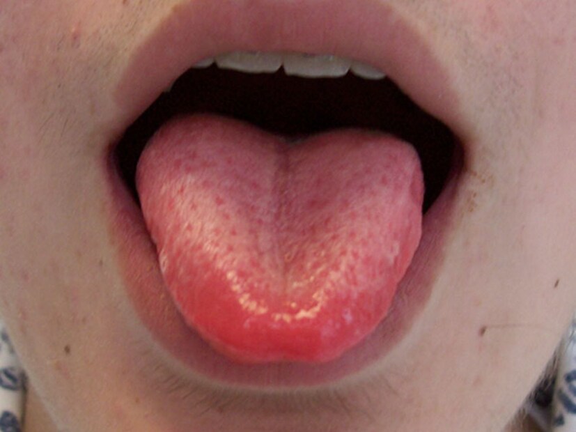 জিভের ডগা লাল (Red Tip Tongue): যদি আপনার জিভের প্রান্ত লাল দেখায়, তাহলে এটি মানসিক চাপ, হৃদয় বা হরমোনাল পরিবর্তনের লক্ষণ হতে পারে। এই অবস্থায় রাতে বালিশের পাশে গোলাপের পাপড়ি, ব্রাহ্মী এবং ল্যাভেন্ডারের গন্ধযুক্ত কোনও জিনিস রেখে ঘুমোন। এটি মনকে শান্তি দেয় এবং ভাল ঘুম আসে।