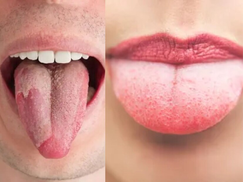 ফ্যাকাশে জিভ (Pale Tongue): যদি জিভ খুব বেশি ফ্যাকাশে বা সাদা দেখায়, তাহলে এটি হিমোগ্লোবিনের অভাব, দুর্বলতা বা অ্যানিমিয়ার দিকে ইঙ্গিত করতে পারে। এই অবস্থায় সকালে ভেজানো অঞ্জির এবং একটু গুড় খাওয়া খুবই উপকারী হয়। এটি রক্তের পরিমাণ বাড়াতে সাহায্য করে এবং শরীরকে শক্তি দেয়।