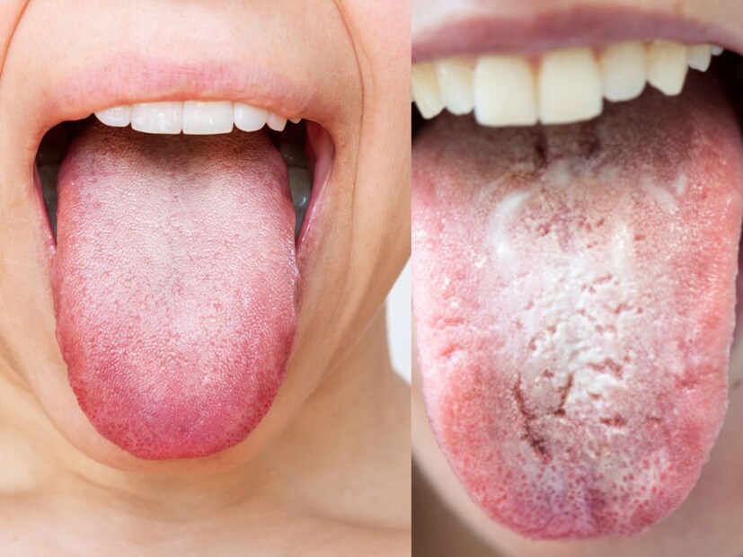 গোলাপি জিভ (Pink Tongue): যদি জিভের রং গোলাপি এবং পরিষ্কার হয়, তাহলে এটি ভাল হজমের লক্ষণ। এর অর্থ আপনি সঠিক খাদ্যাভ্যাস এবং জীবনযাপন করছেন। তবুও, শরীরের টিস্যুকে পুষ্টি দেওয়ার জন্য রাতে ১ চামচ দেশি ঘি অবশ্যই নিন।
