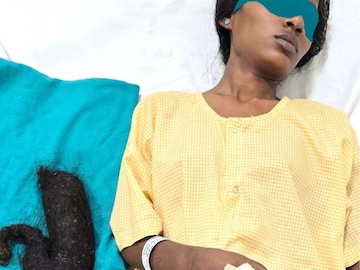 Hair Eating Woman: চুল খেয়ে পেটের ভেতরে আধা কেজির চুলের গাঁট! অপারেশনে প্রাণ বাঁচল তরুণীর…
