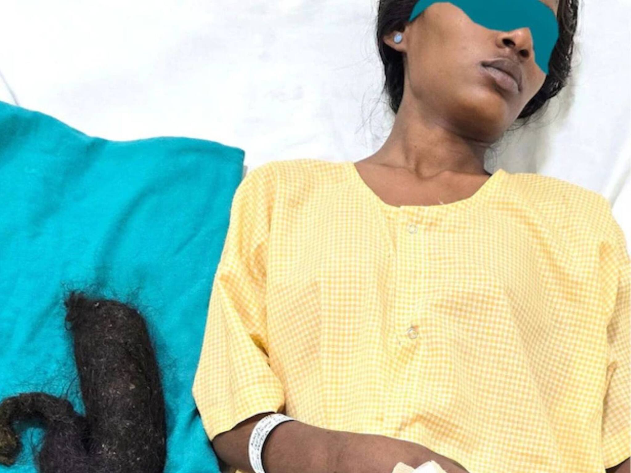Hair Eating Woman: চুল খেয়ে পেটের ভেতরে আধা কেজির চুলের গাঁট! অপারেশনে প্রাণ বাঁচল তরুণীর...