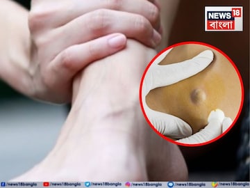 Cancer: পায়ে ফোলাভাব! দলা বেধেছে মাংসপিণ্ড? ভুলেও এড়িয়ে যাবেন না…! এটাই ‘বিরল ক্যানসার’-এর লক্ষণ, জানুন কী বলছেন চিকিৎসক? Cancer: পায়ে ফোলাভাব! দলা বেধেছে মাংসপিণ্ড? ভুলেও এড়িয়ে যাবেন না…! এটাই ‘বিরল ক্যানসার’-এর লক্ষণ, জানুন কী বলছেন চিকিৎসক?