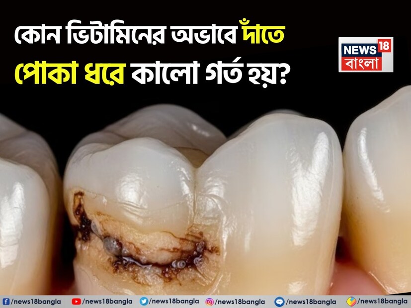 দাঁত আমাদের শরীরের একটি গুরুত্বপূর্ণ অঙ্গ, যা কেবল আমাদের মুখের সৌন্দর্যই বৃদ্ধি করে না বরং সুস্বাস্থ্যের লক্ষণ হিসেবেও বিবেচিত হয়। কিন্তু আজকের জীবনযাত্রা এবং খাদ্যাভ্যাস দাঁতের উপর খারাপ প্রভাব ফেলছে। অল্প বয়সে দাঁতের ক্ষয়, ব্যথা, মাড়ি ফুলে যাওয়া এবং গর্তের মতো সমস্যা দ্রুত বৃদ্ধি পাচ্ছে। সময়মতো মনোযোগ না দিলে দাঁত দুর্বল হয়ে পড়ে যেতে পারে। তবে, একটি বিশেষ ভিটামিন আছে, যা এই সমস্যা থেকে দাঁত রক্ষা করতে খুব বড় ভূমিকা পালন করতে পারে। আমরা ভিটামিন ডি সম্পর্কে কথা বলছি, যা দাঁতের শক্তির জন্য অত্যন্ত গুরুত্বপূর্ণ বলে বিবেচিত হয়।