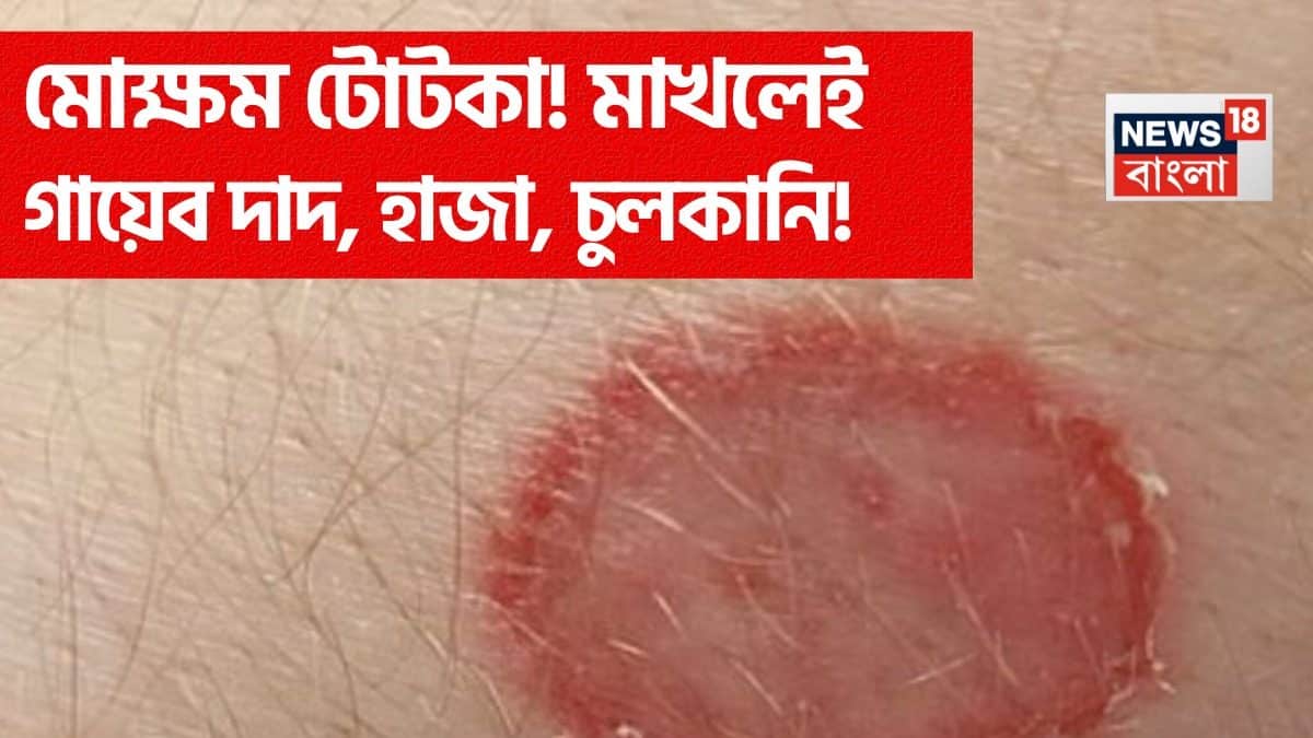 Daad Skin Problem Skin Disease: নারকেল তেলে ‘এটা’ জাস্ট ১ চামচ মিশিয়ে গায়ে মাখলেই ...