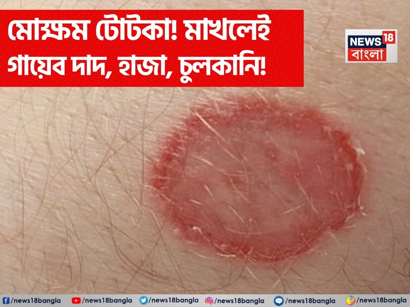 বৃষ্টি এবং গ্রীষ্মের আর্দ্র ঋতুতে শরীরে ছত্রাক সংক্রমণ এবং চুলকানির ঝুঁকি খুব বেশি থাকে। সাধারণত গ্রীষ্মকালে মানুষ ছত্রাক সংক্রমণের কারণে খুব বেশি সমস্যায় পড়ে। আজ আমরা আপনাকে এর চিকিৎসার ঘরোয়া প্রতিকার সম্পর্কে বলব যা এই সমস্যা থেকে মুক্তি পেতে খুবই কার্যকর হতে পারে।