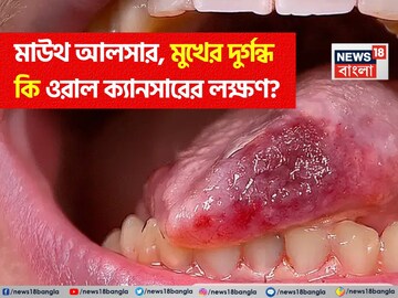মাউথ আলসার, মুখে দীর্ঘস্থায়ী পচা দুর্গন্ধ থেকে কি ওরাল ক্যানসার হয়? জানুন এই রোগের লক্ষণ