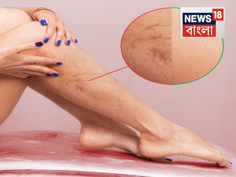 এই রোগের মূল উপসর্গগুলির মধ্যে রয়েছে, ফোলা পা, গোড়ালিতে ফোলাভাব, পায়েতে টান ধরা, শিরা ফুলে নীল হয়ে যাওয়া, যন্ত্রণা এবং ত্বকের রং বদলে যাওয়া৷ 