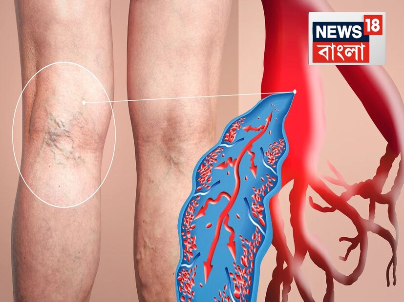 ‘ক্রনিক ভেনাস ইনসাফিসিয়েন্সি’ নামক এই রোগে শিরার কর্মক্ষমতা কমে যায়৷ ধমনীর ভালভ দুর্বল হয়ে পড়ে৷ ফলে শিরা-ধমনীর মতো রক্তবাহে ফ্লুইড বা রক্ত জমাট বাঁধতে শুরু করে৷ বয়স্ক মানুষদের ক্ষেত্রে এই সমস্যা দেখা দেয়৷ 