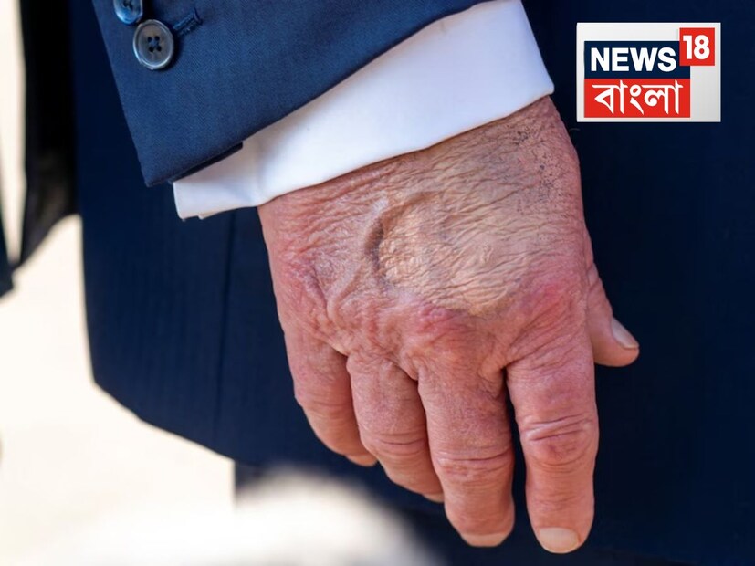 এখানেই শেষ নয়৷ ওই দিন খুঁড়িয়ে খুঁড়িয়ে হাঁটতে দেখা গিয়েছে ট্রাম্পকে৷ তারপর থেকেই আমেরিকা তো বটেই, আন্তর্জাতিক স্তরেও শুরু হয়ে গিয়েছিল জল্পনা৷ তাহলে কি ট্রাম্প গুরুতর অসুস্থ? পা ফুলে ওরকম টইটম্বুর কেন? হাতেই বা ওটা কী নীল দাগ? পরিস্থিতি এমনই পর্যায়ে পৌঁছয় যে ট্রাম্পের স্বাস্থ্য নিয়ে বিবৃতি জারি করতে হয় হোয়াইট হাউসকে৷