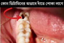 কালো গর্ত, প্রবল যন্ত্রণা! কোন ভিটামিনের অভাবে দাঁতে পোকা লাগে জানেন?