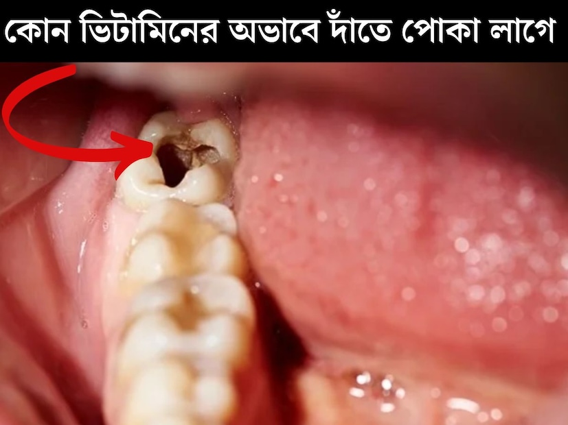 ঝকঝকে দাঁত আরও বাড়িয়ে দেয় হাসির সৌন্দর্য‍্য। কিন্তু এখন দাঁতের সমস‍্যাতে ভুগছেন প্রচুর। বয়স নির্বিশেষে দাঁতে পোকার যন্ত্রণায় কষ্ট পাচ্ছেন অনেকেই। প্রায় প্রতিটি পরিবারেই কোনও না কোনও সদস‍্য দাঁত নিয়ে সমস‍্যায় রয়েছেন। 